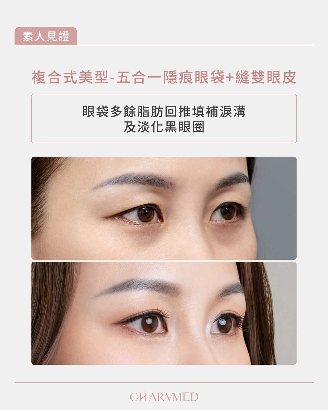 誠美學診所媽媽雙眼皮眼袋手術02