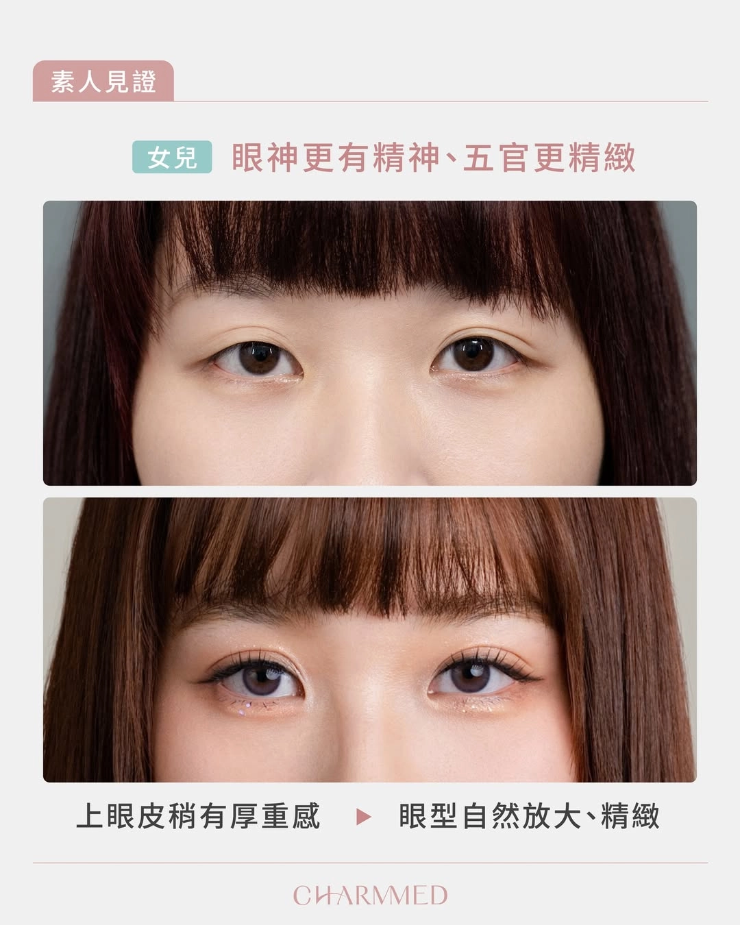 誠美學診所女兒雙眼皮手術