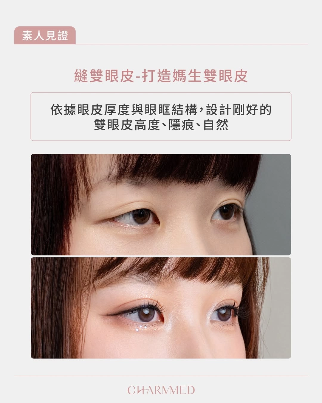 誠美學診所女兒雙眼皮手術02