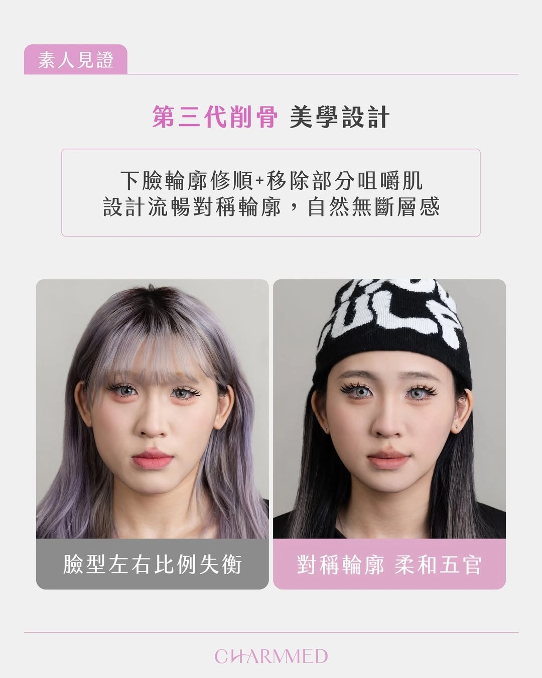 第三代削骨矯正臉部設計