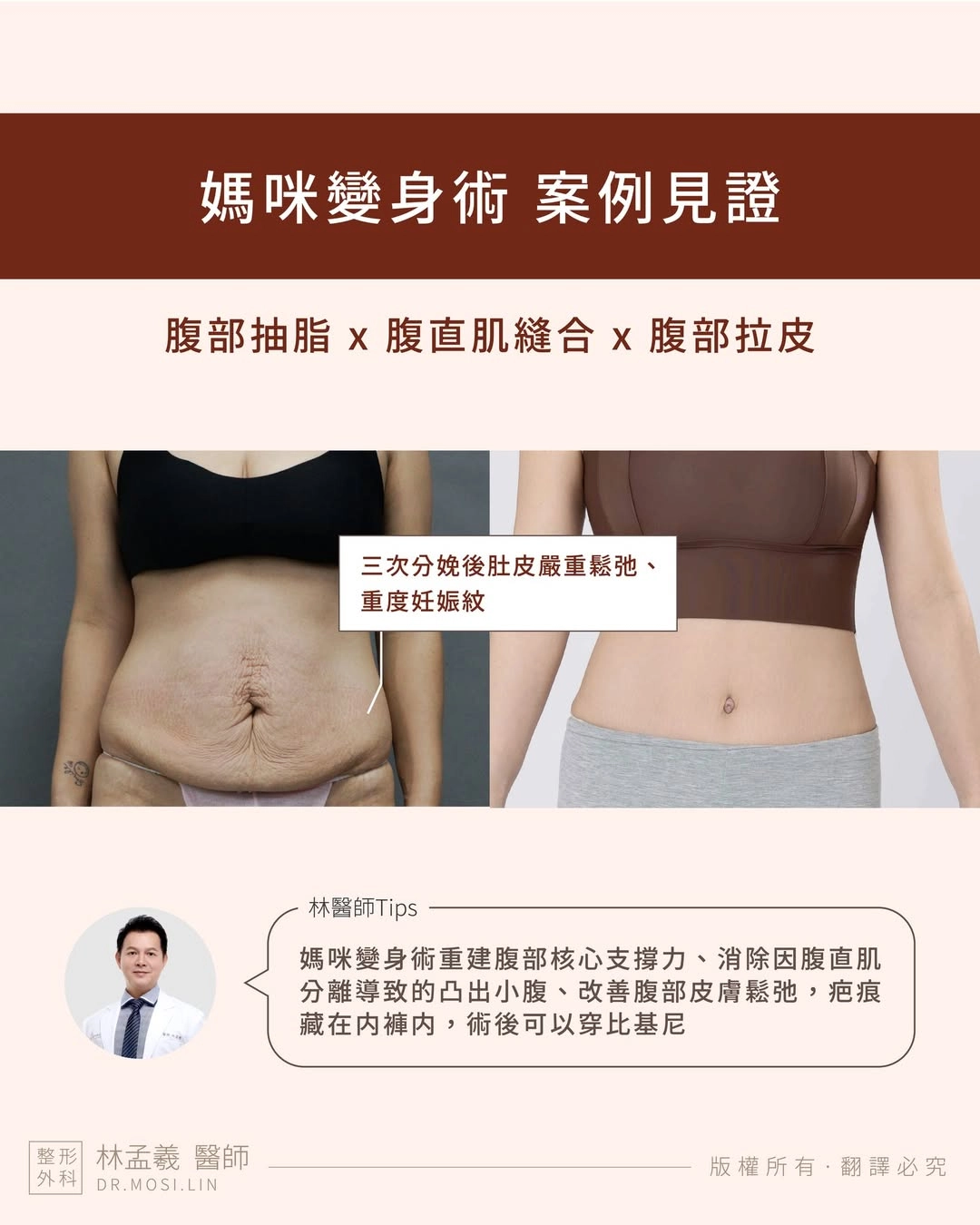 媽咪變身術|腹部抽脂×腹直肌縫合×腹部拉皮