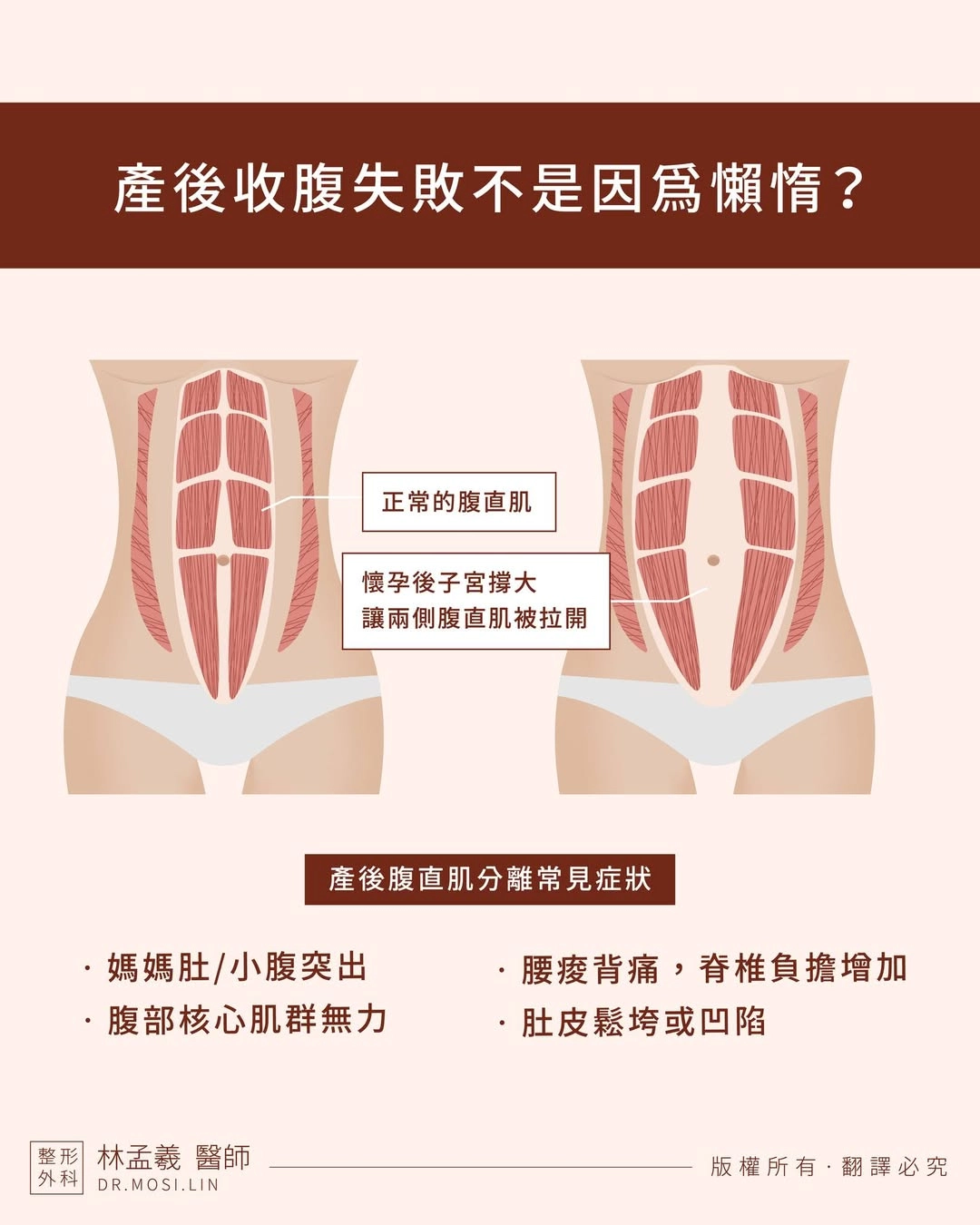 產後收腹失敗不是因為懶惰!是腹直肌分離