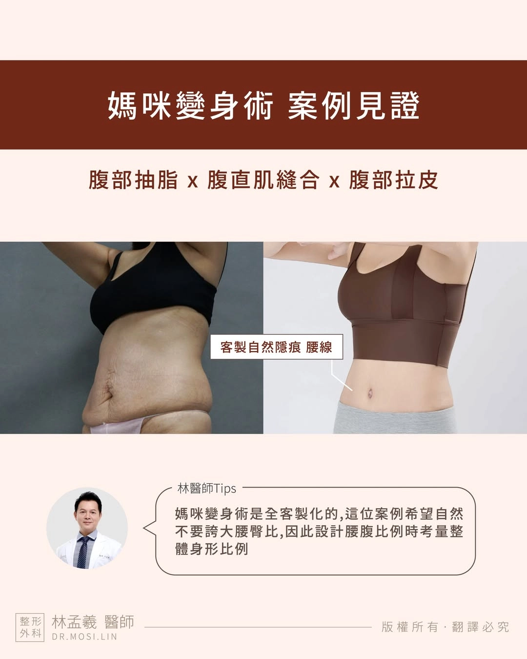 媽咪變身術是全客製化設計療程