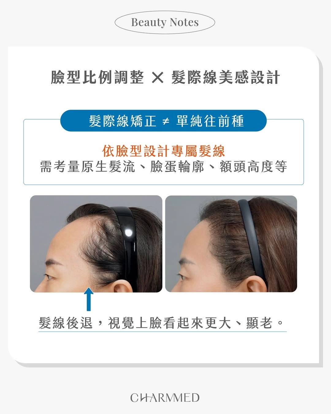 台中誠美學診所女性植髮臉型設計