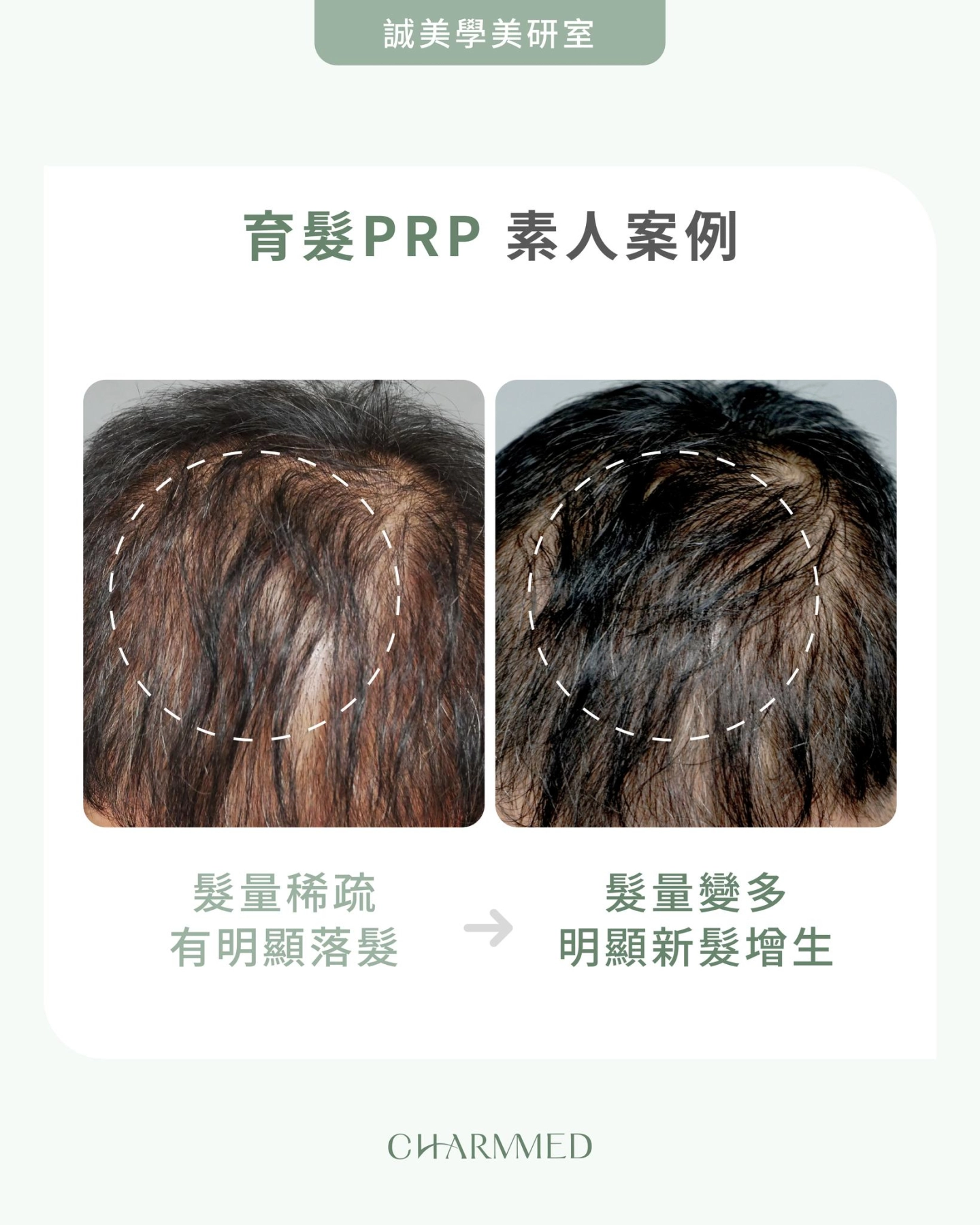 台中誠美學診所吳明憲醫師 - 自體PRP育髮真實案例