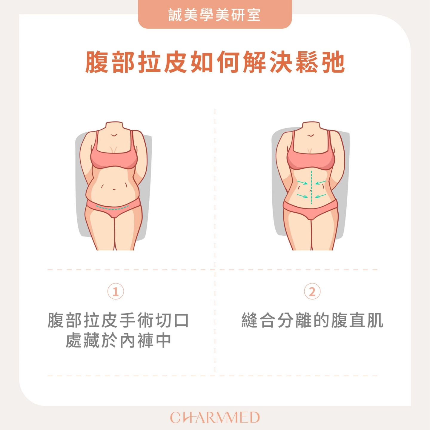 產後腹部拉皮手術簡述-台中 誠美學診所 整形外科衛教