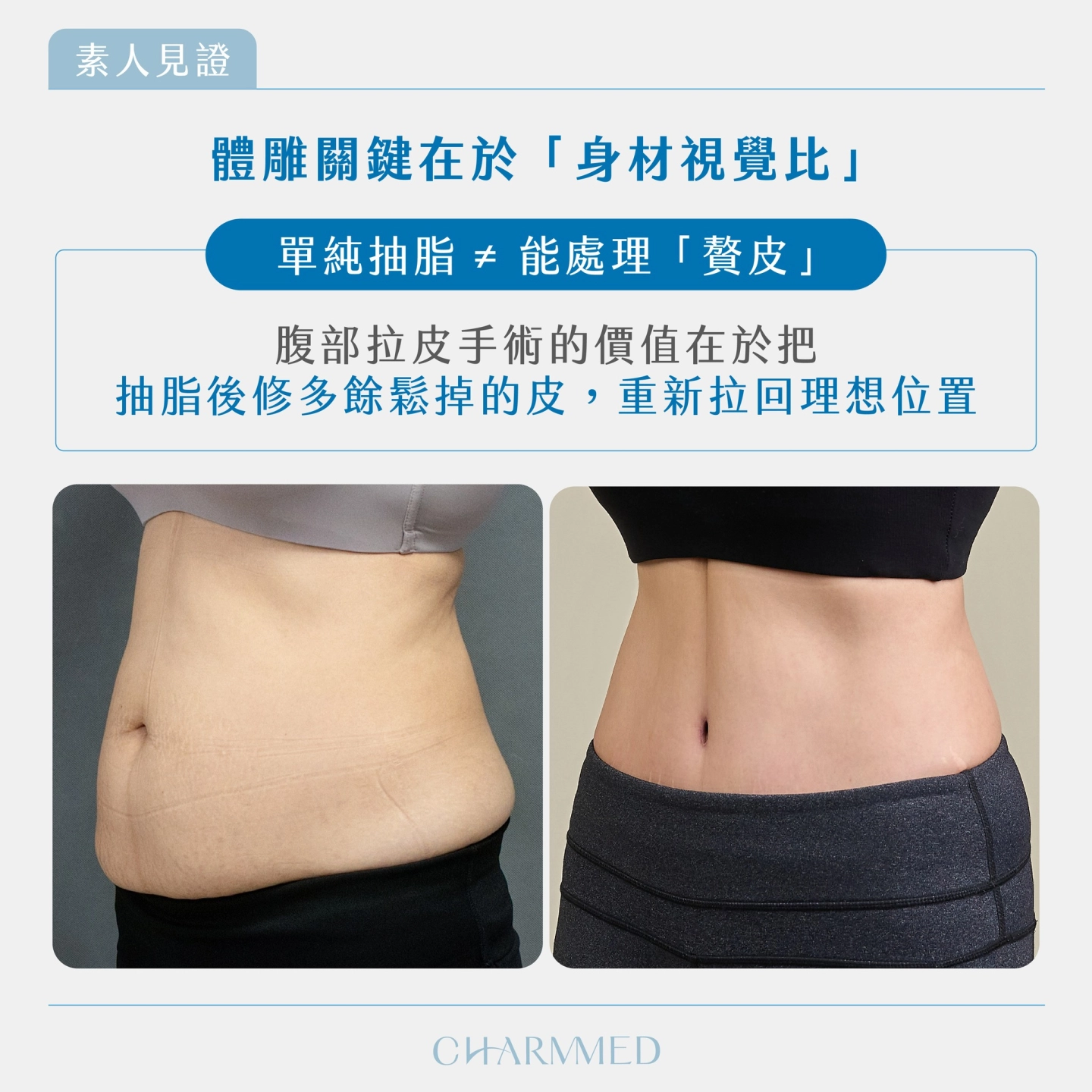 資深整形外科吳明憲醫師 產後腹部拉皮體雕規劃及真實案例-台中 誠美學診所 整形外科衛教