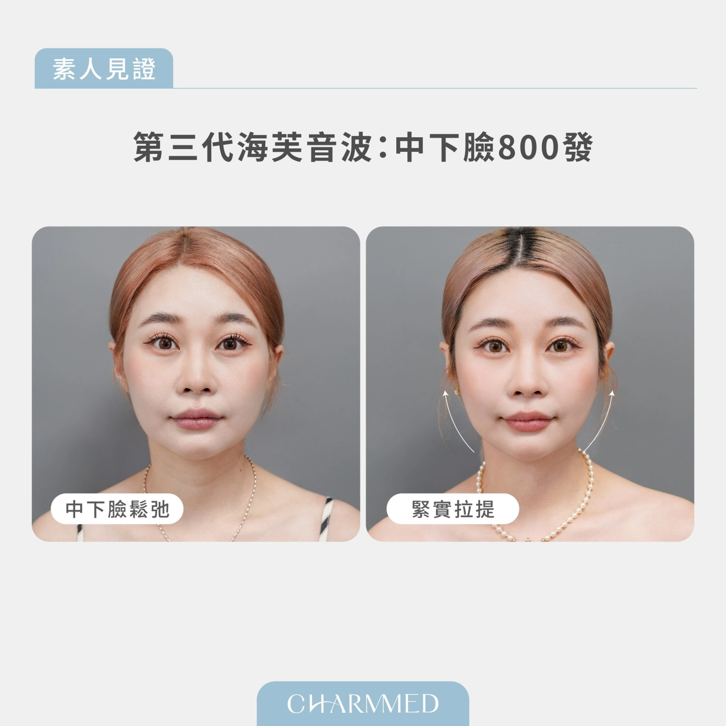 誠美學診所海芙音波