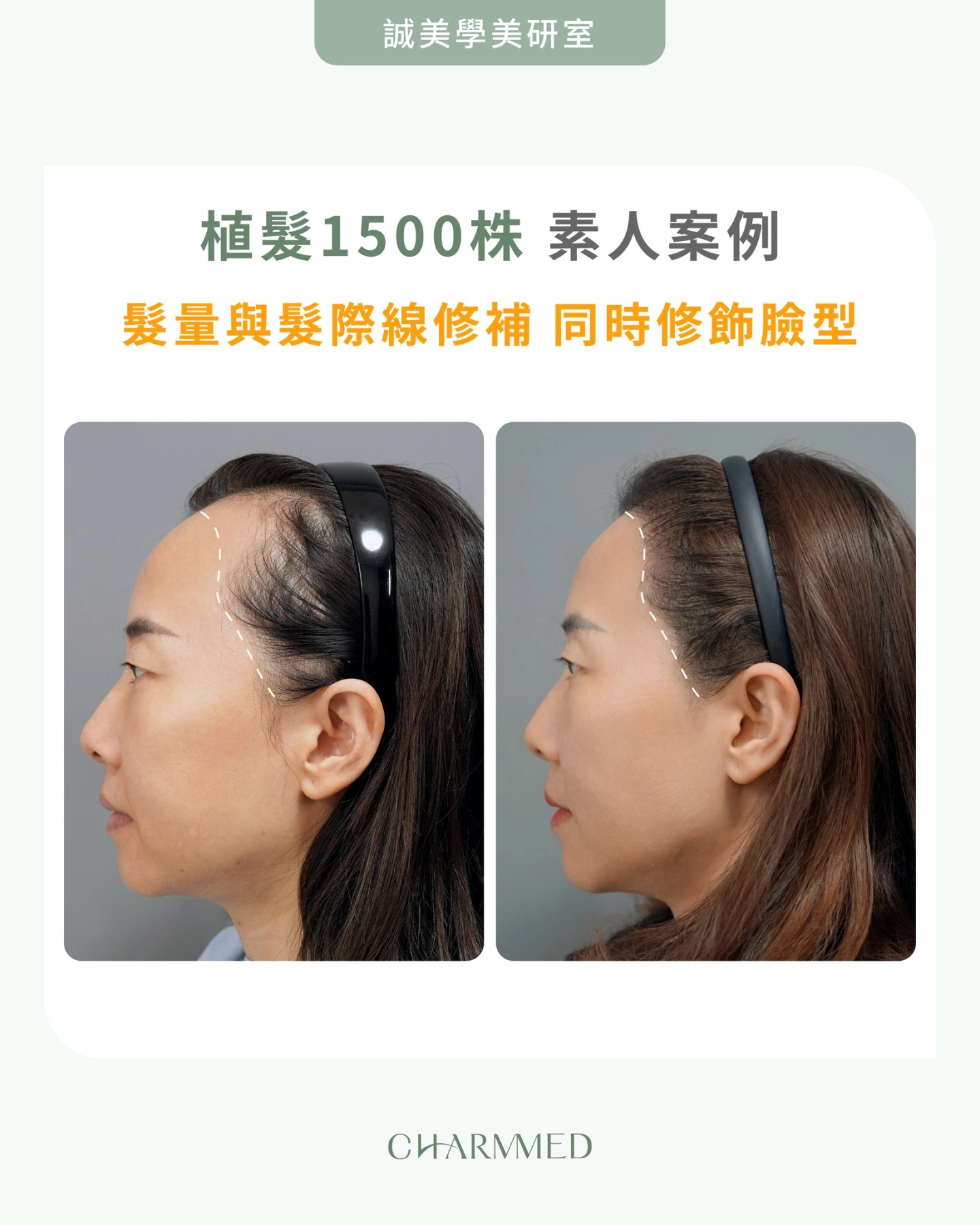 誠美學診所植髮素人案例