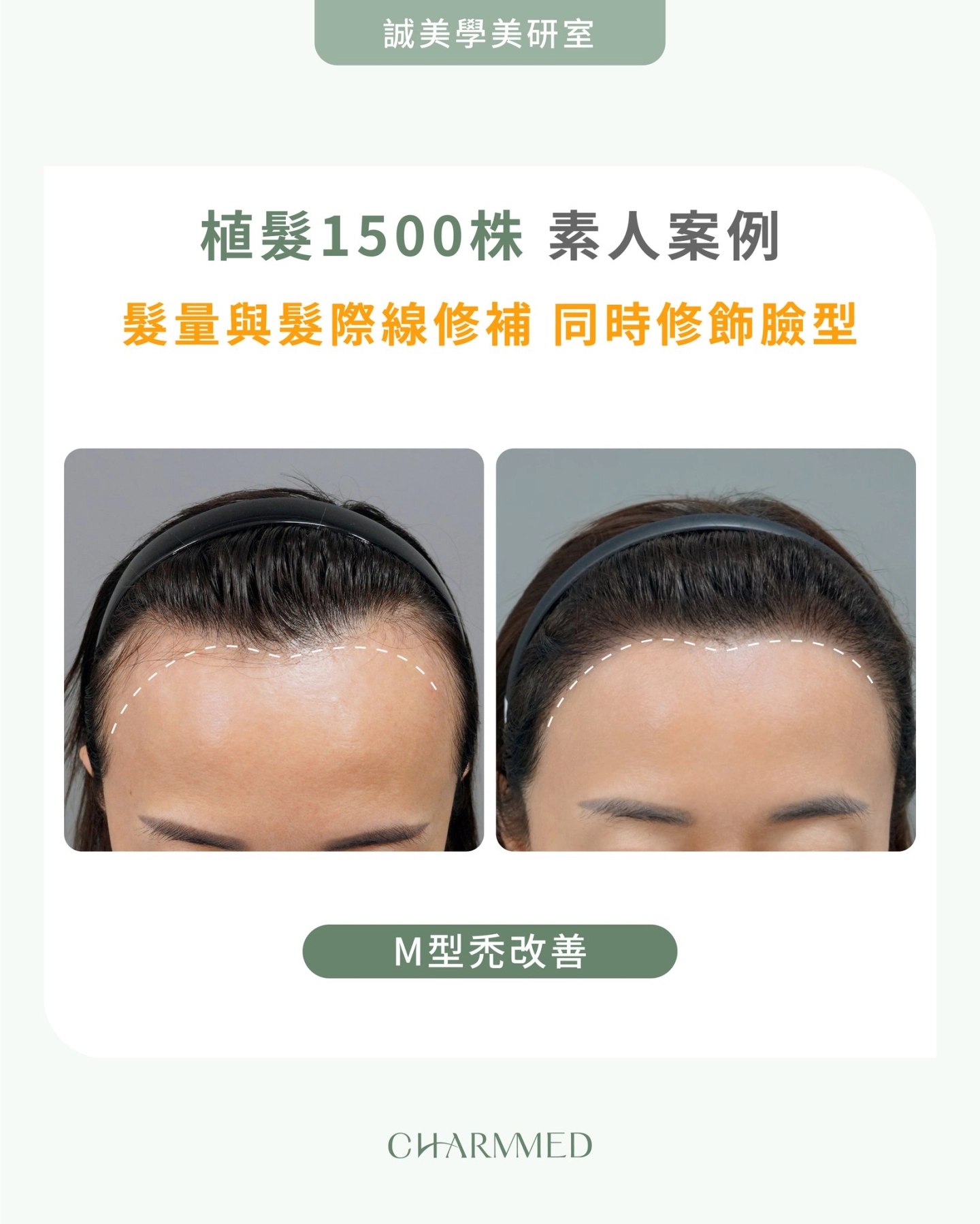 誠美學診所醫師植髮案例