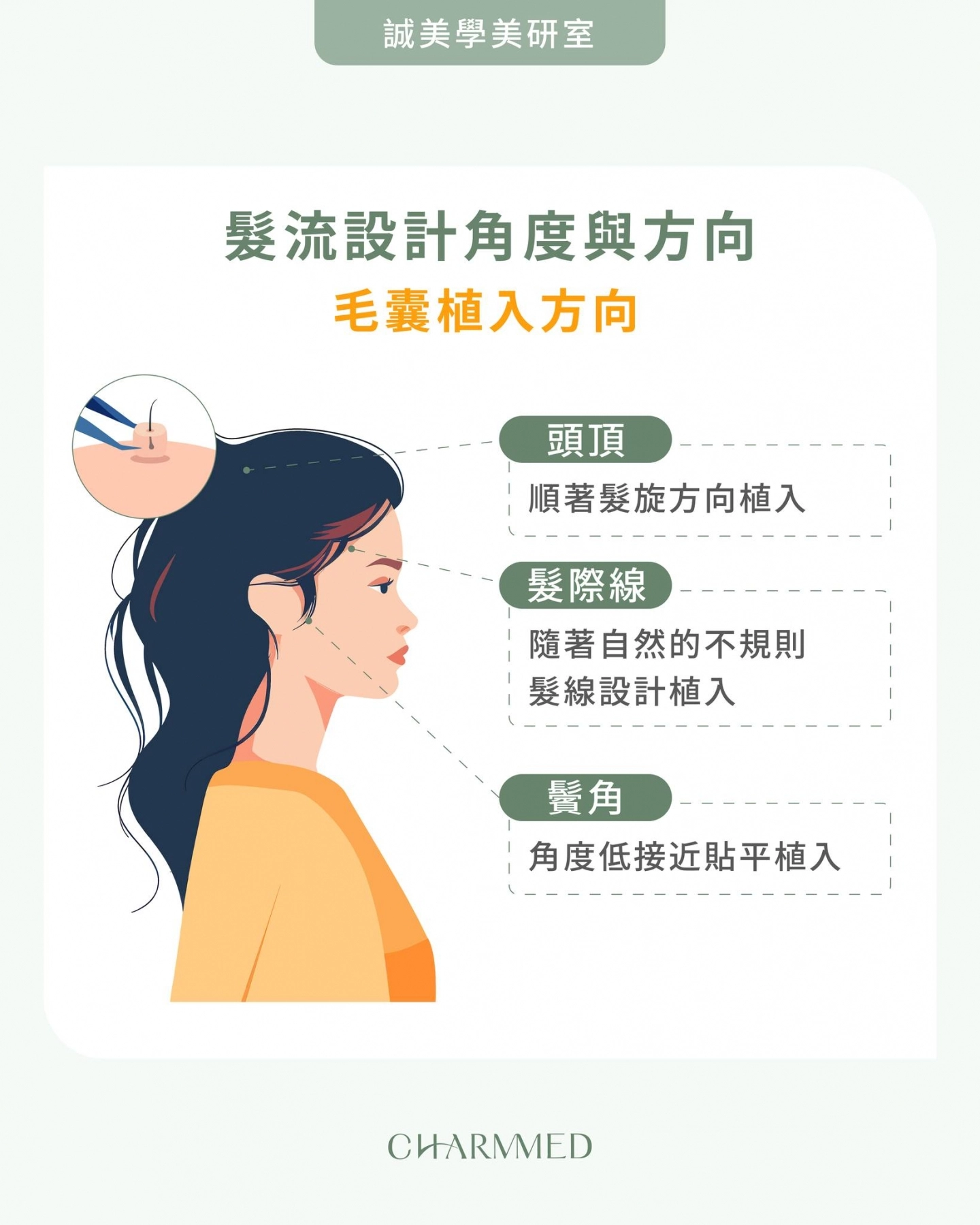 植髮髮流設計角度與方向