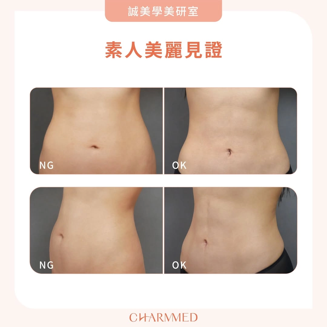 產後肚皮下垂鬆弛 恢復平坦腹