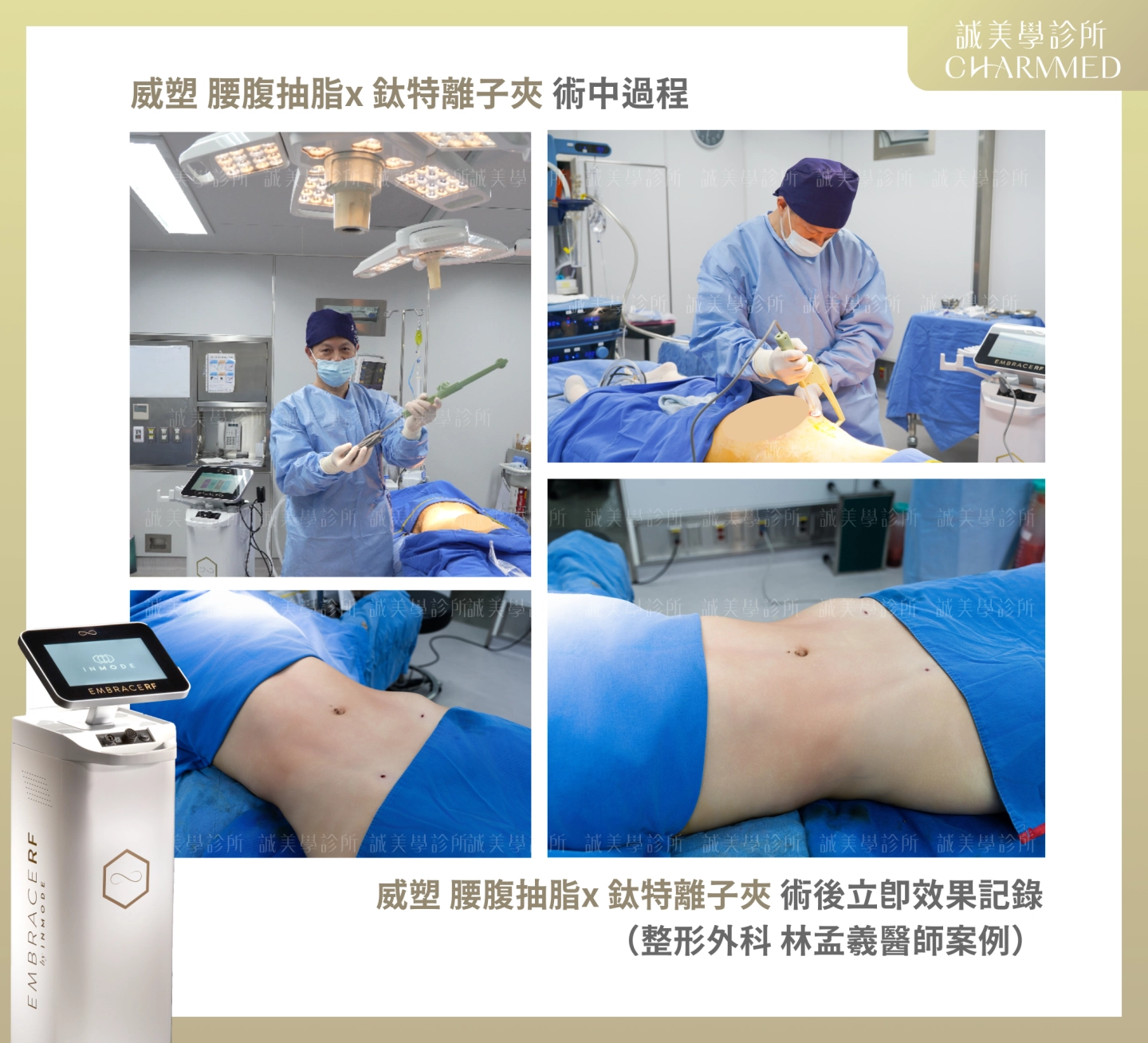 威塑 腰腹抽脂x 鈦特離子夾 術中過程&立即效果記錄-整形外科林孟羲醫師案例