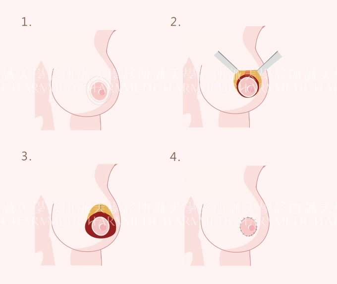 誠美學診所提乳縮乳療程介紹環狀乳暈切口
