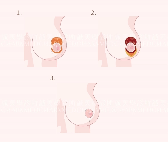 誠美學診所提乳縮乳療程介紹垂直切口