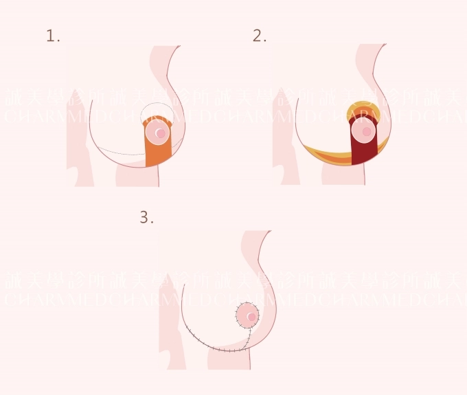 誠美學診所提乳縮乳療程介紹倒T