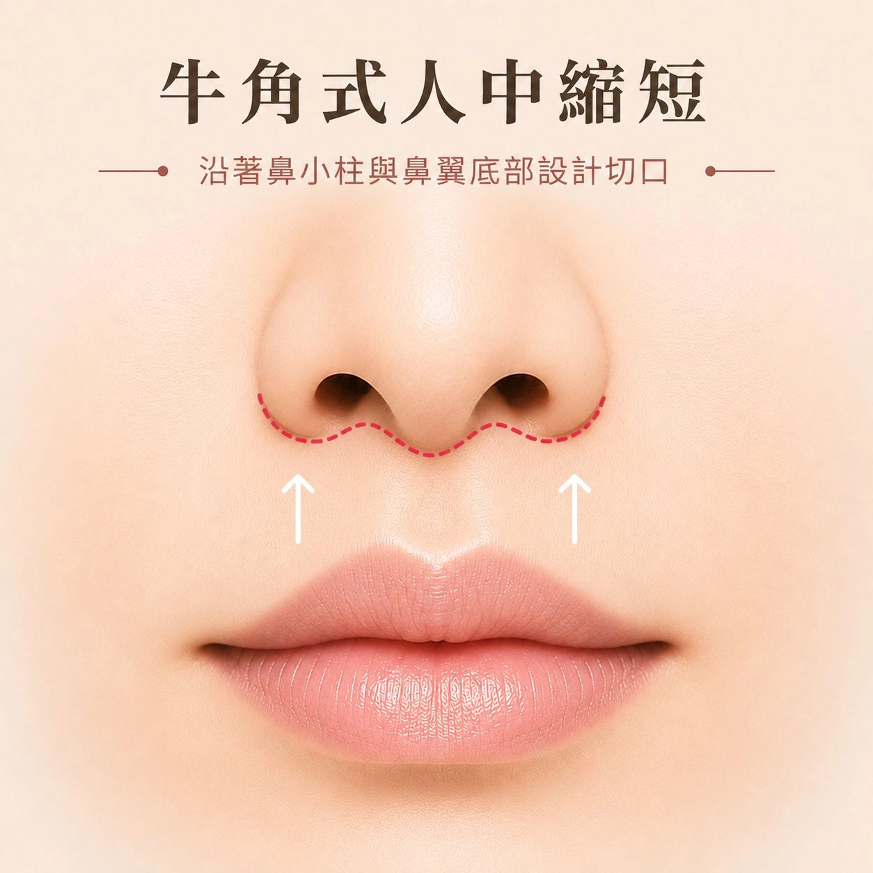 牛角式人中縮短