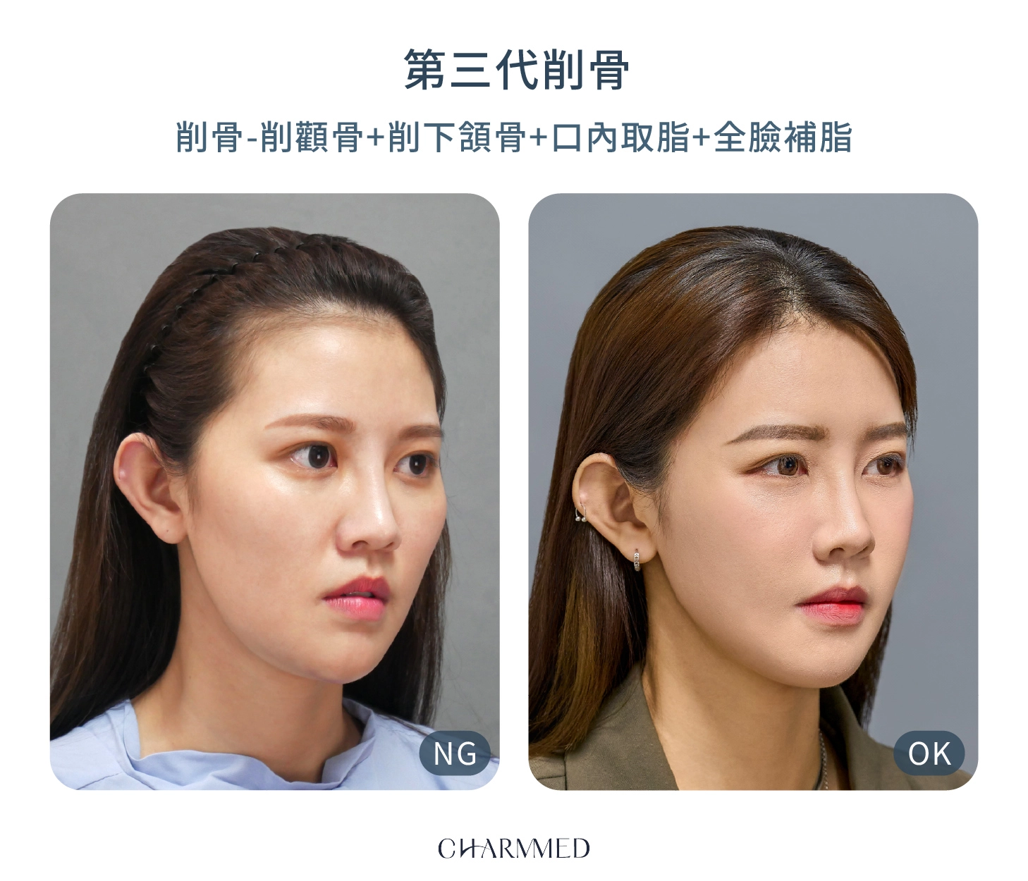 誠美學診所林孟羲醫師第三代削骨複合式