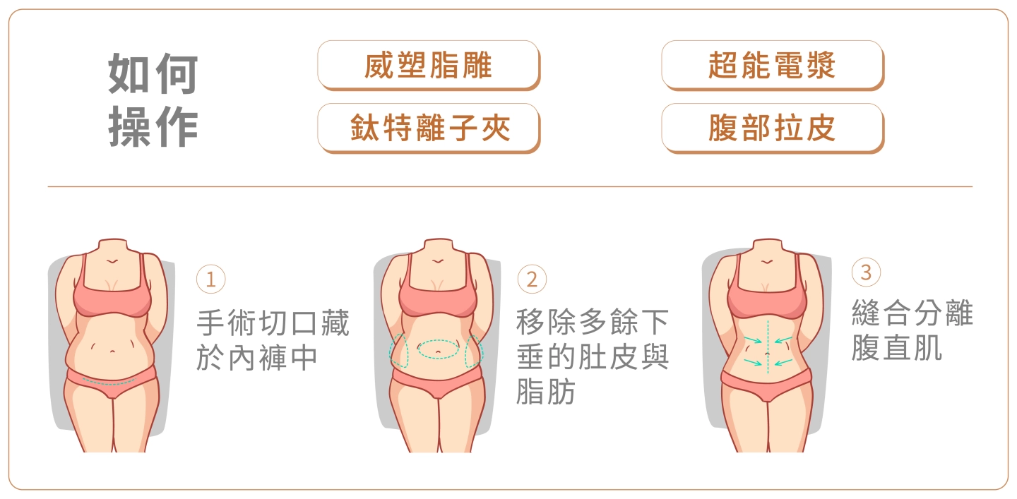 台中誠美學診所腹部拉皮流程