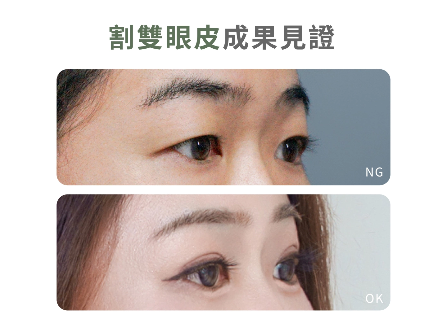 誠美學診所割雙眼皮成果見證