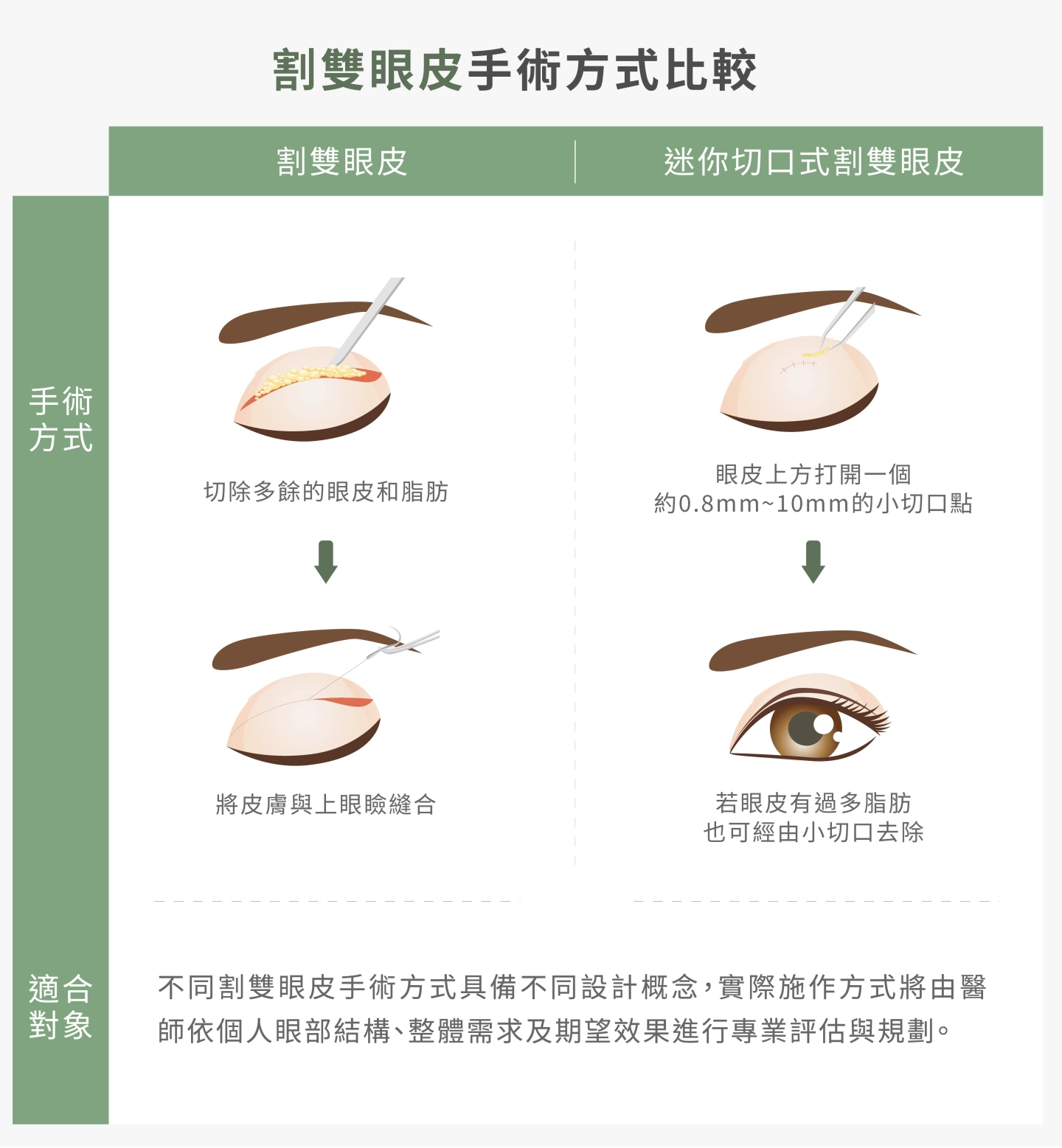 誠美學診所割雙眼皮比較
