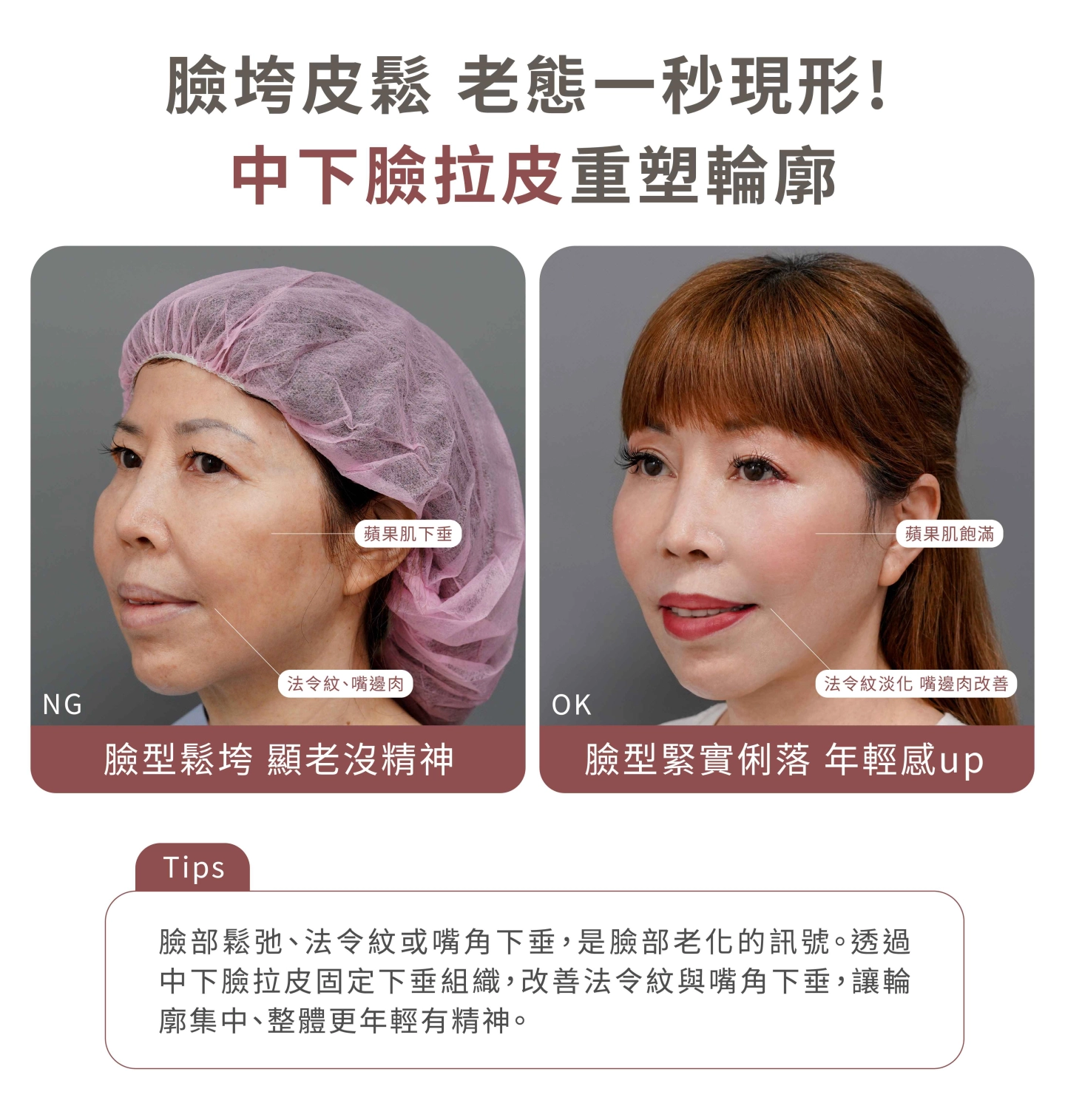 誠美學中下臉拉皮施作部位