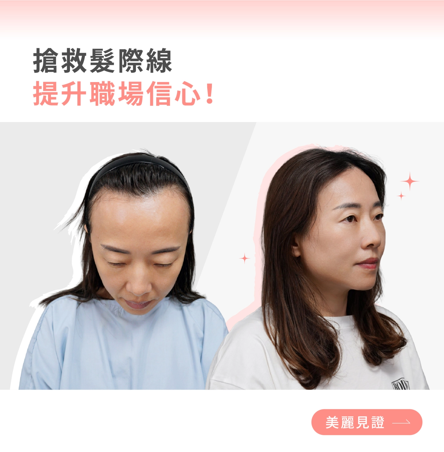 台中誠美學吳明憲醫師植髮案例見證