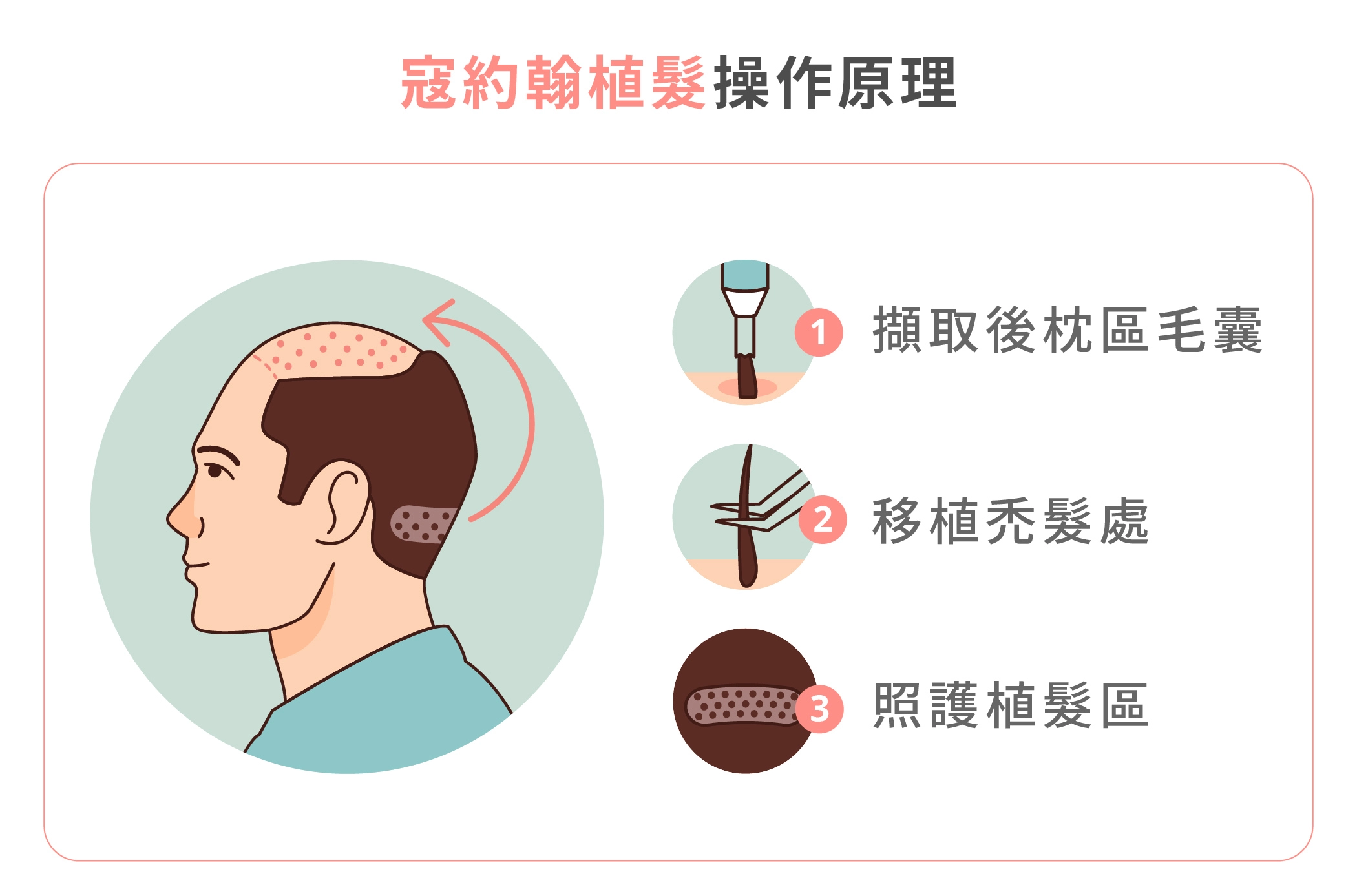 寇約翰植髮手術操作原理介紹説明