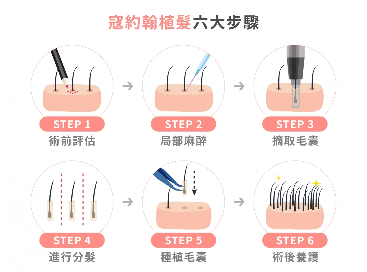 寇約翰植髮步驟説明