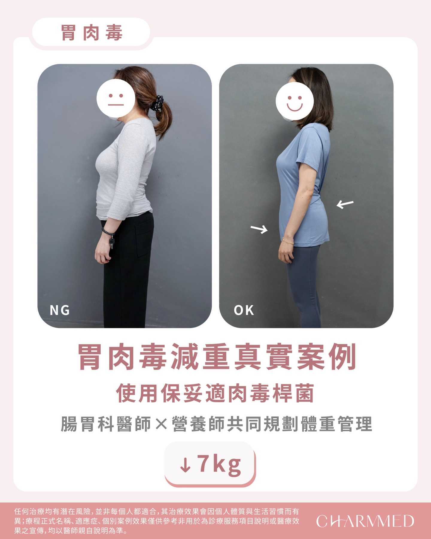 胃肉毒減重見證|-7KG穩定減重不反彈,重回輕盈體態