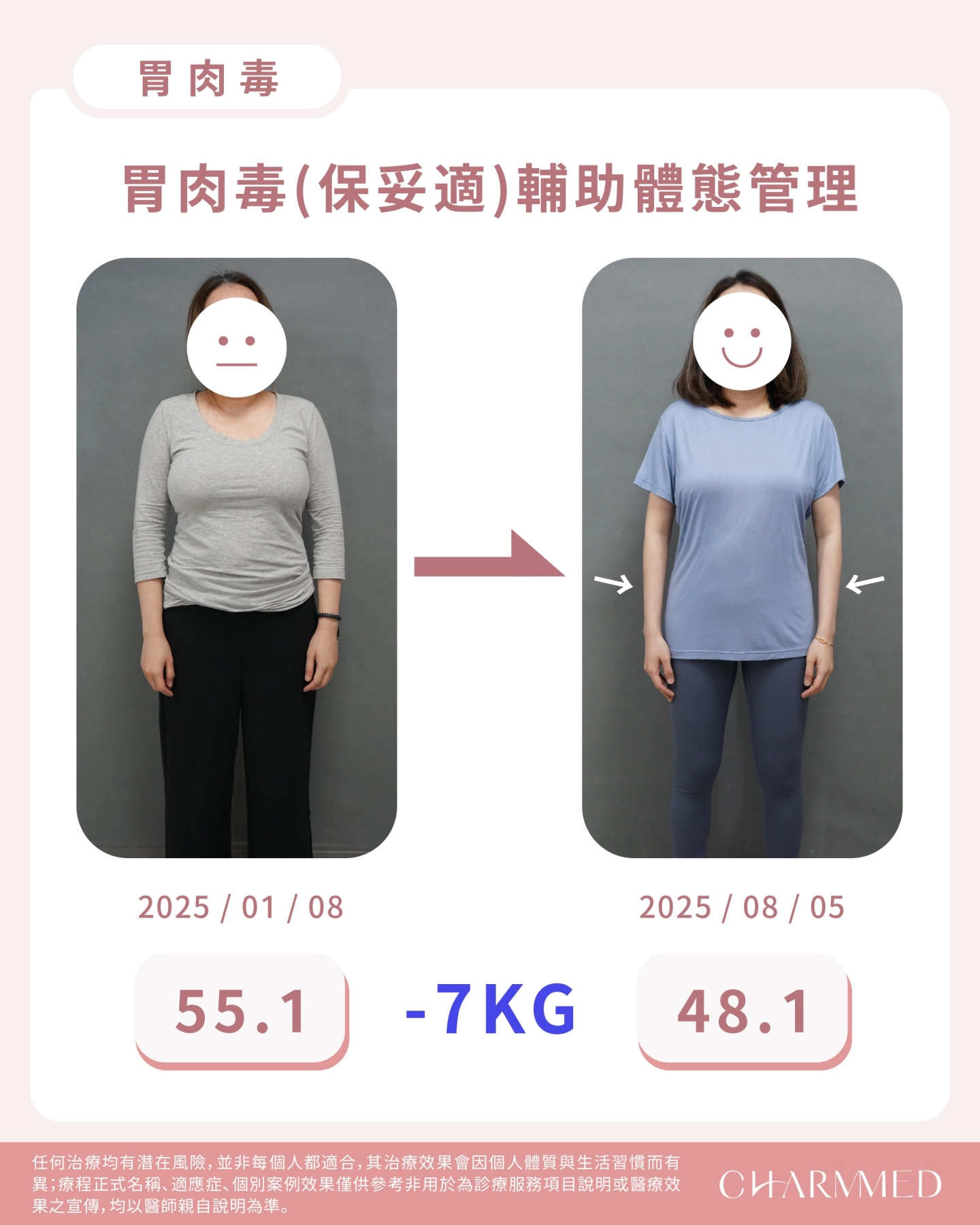 誠美學診所胃肉毒療程特色