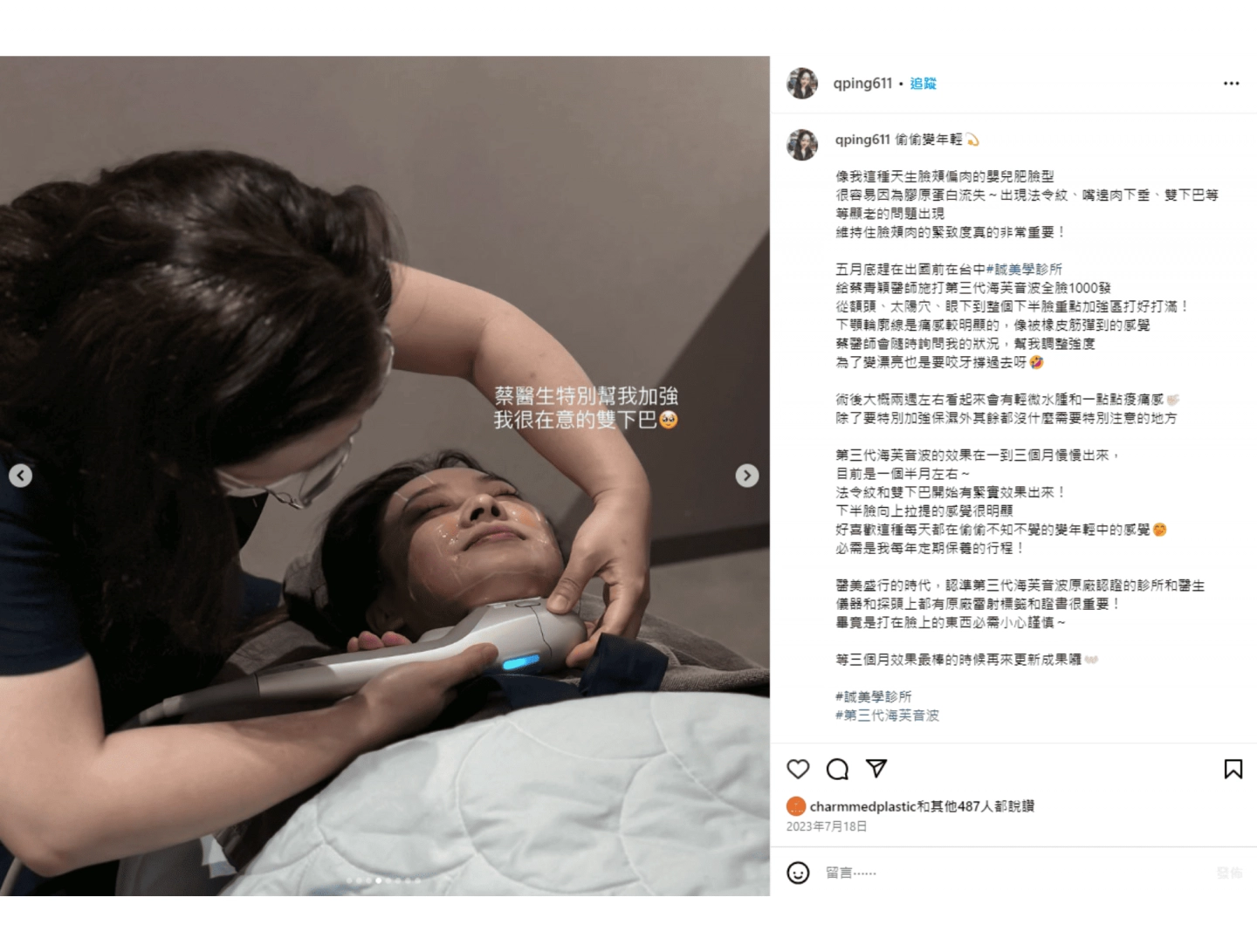 誠美學診所海芙音波蔡青穎醫師打雙下巴