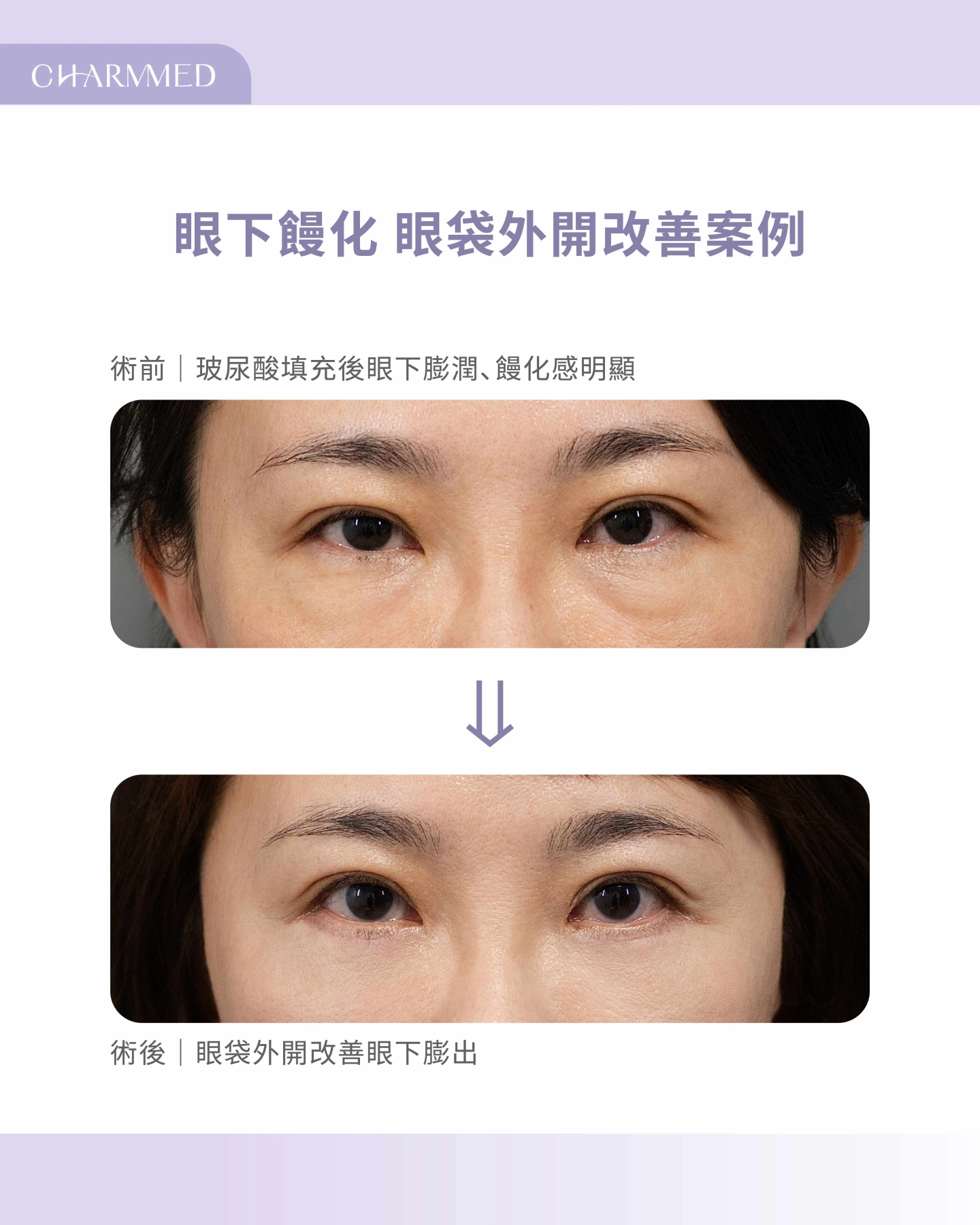 案例分享｜眼袋玻尿酸饅化後，透過眼袋外開改善