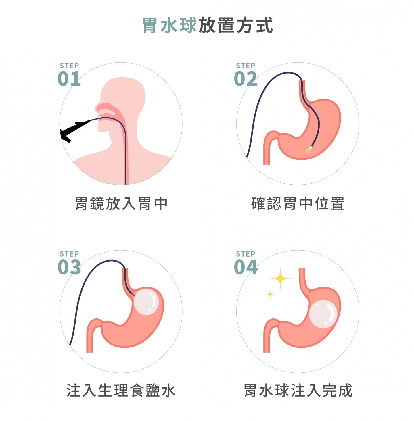 胃水球放置方式