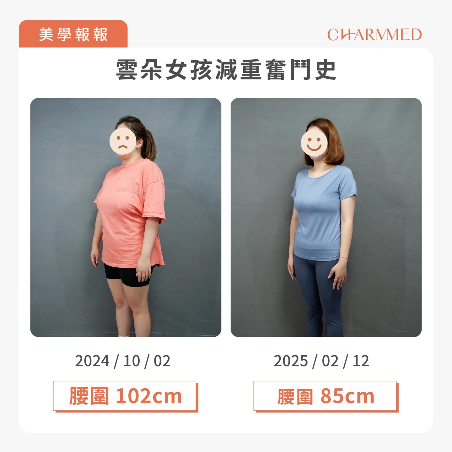 誠美學胃水球置放術後4個月腰圍變化