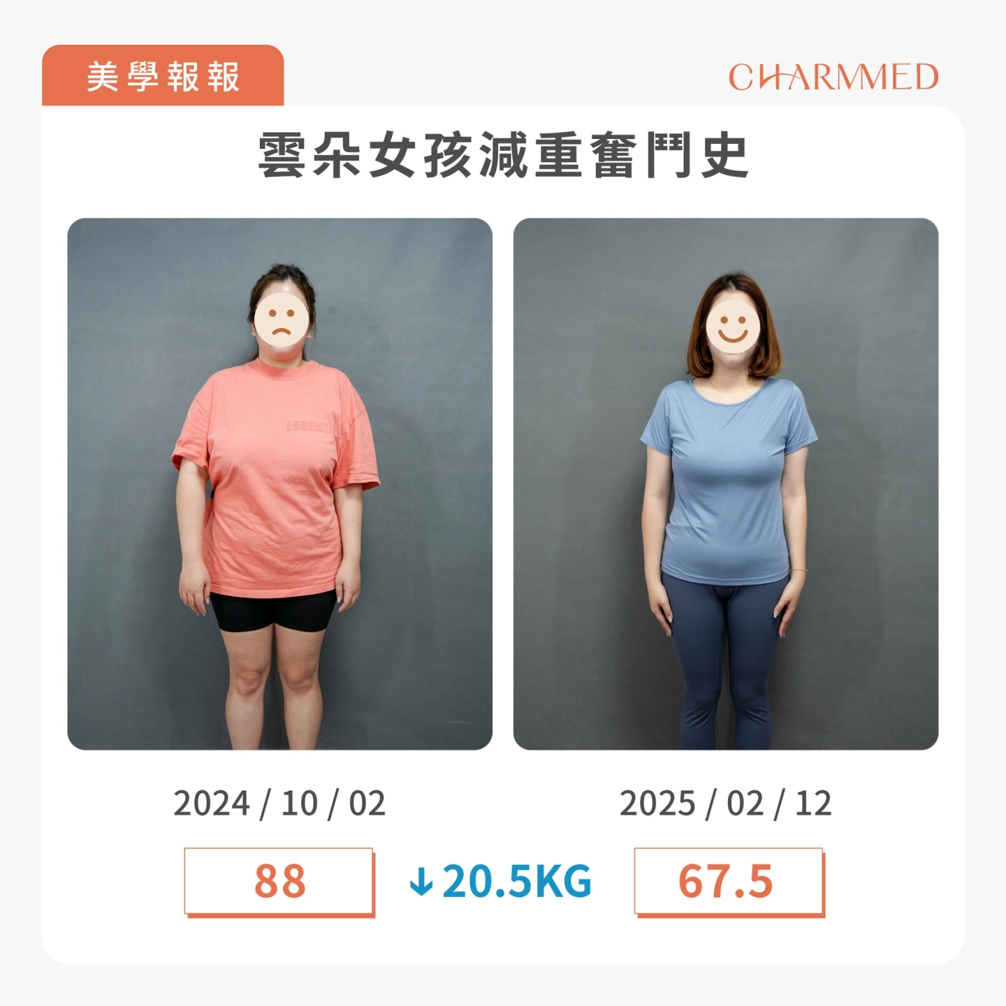 誠美學胃水球置放術後4個月體重穩定下降