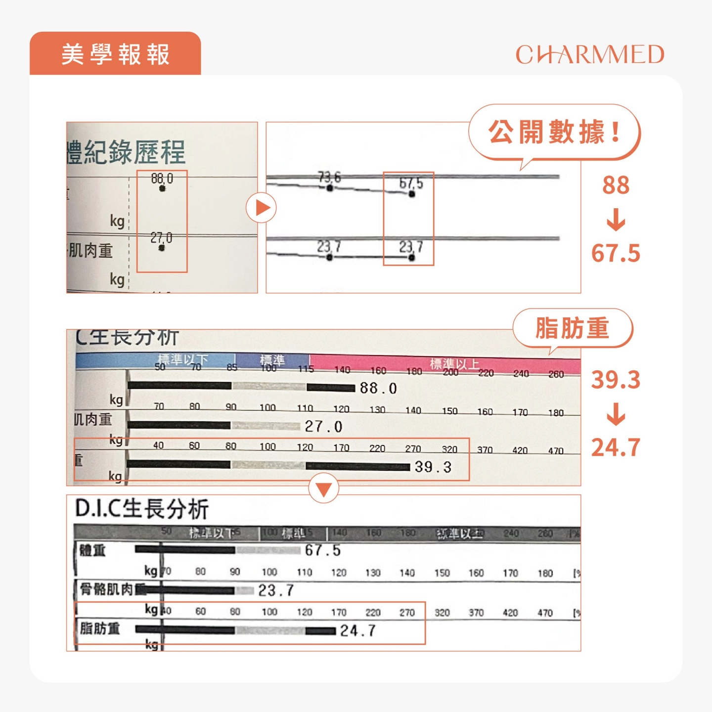 誠美學胃水球置放術後數據公開