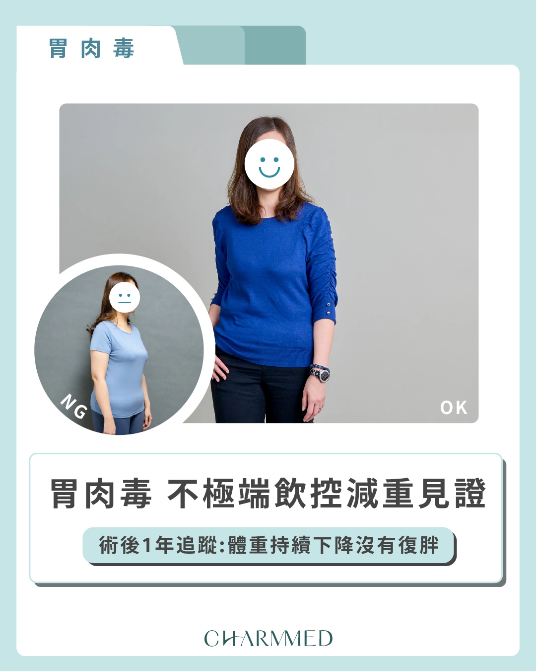 胃肉毒減重案例分享：不挨餓！術後一年追蹤持續塑身