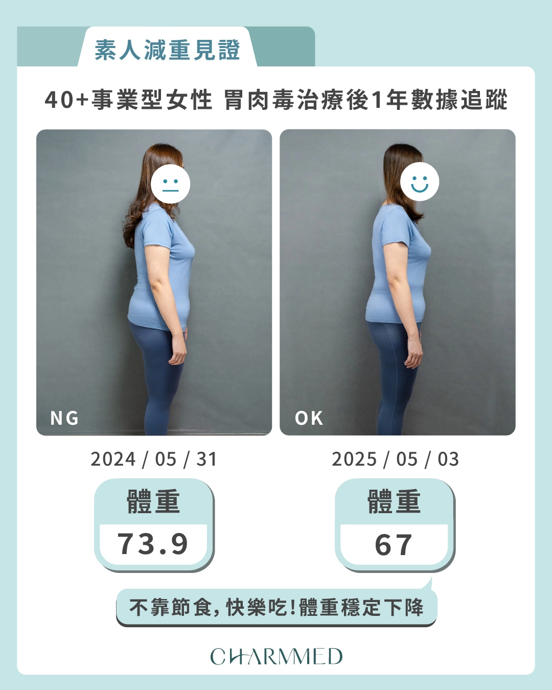 胃肉毒減重術後一年追蹤