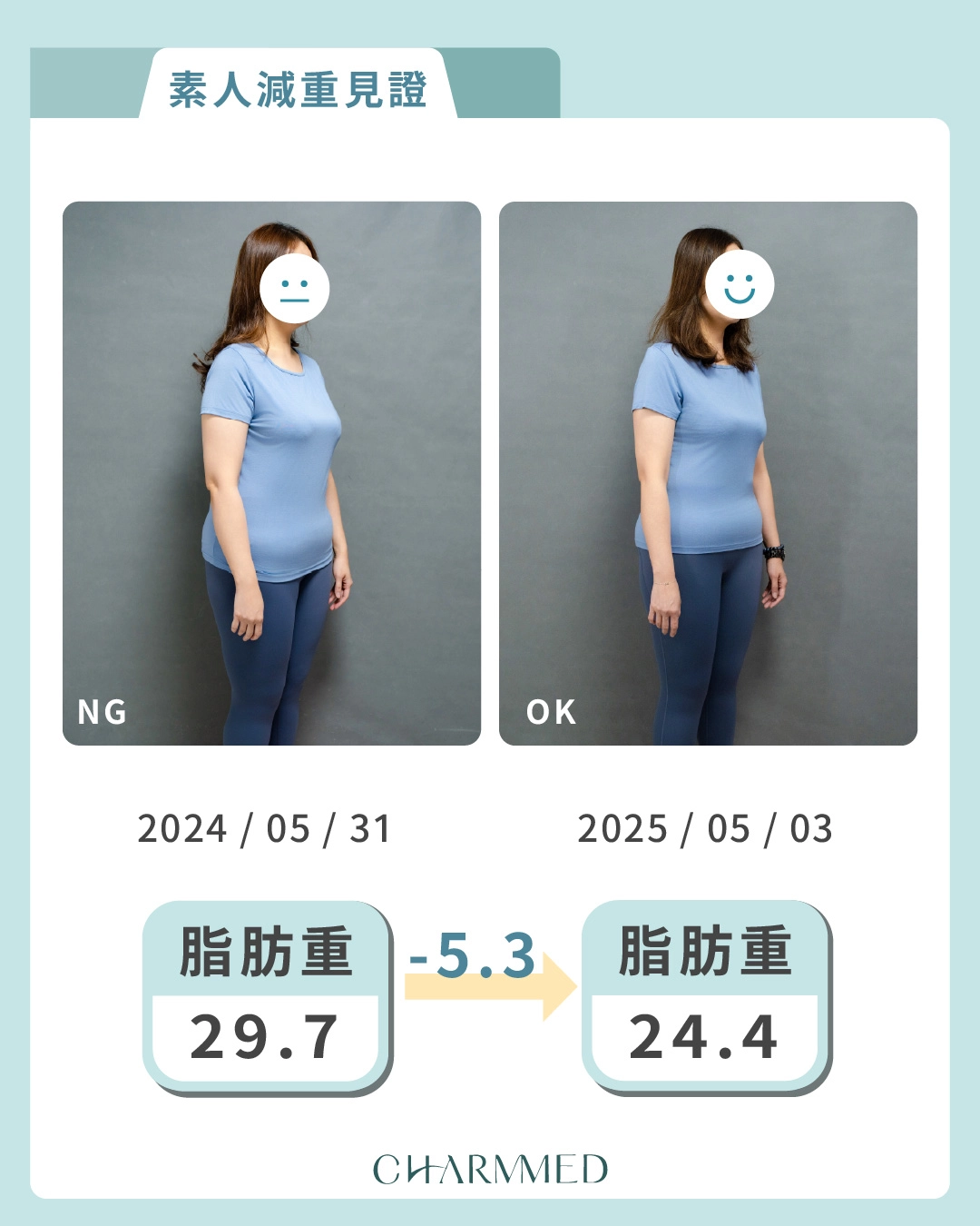 胃肉毒減重案例分享脂肪變化