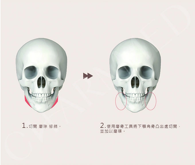 誠美學診所下頷骨削骨療程手術方式
