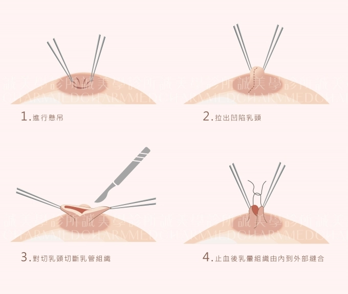 誠美學診所乳頭凹陷手術療程介紹乳頭拉提術