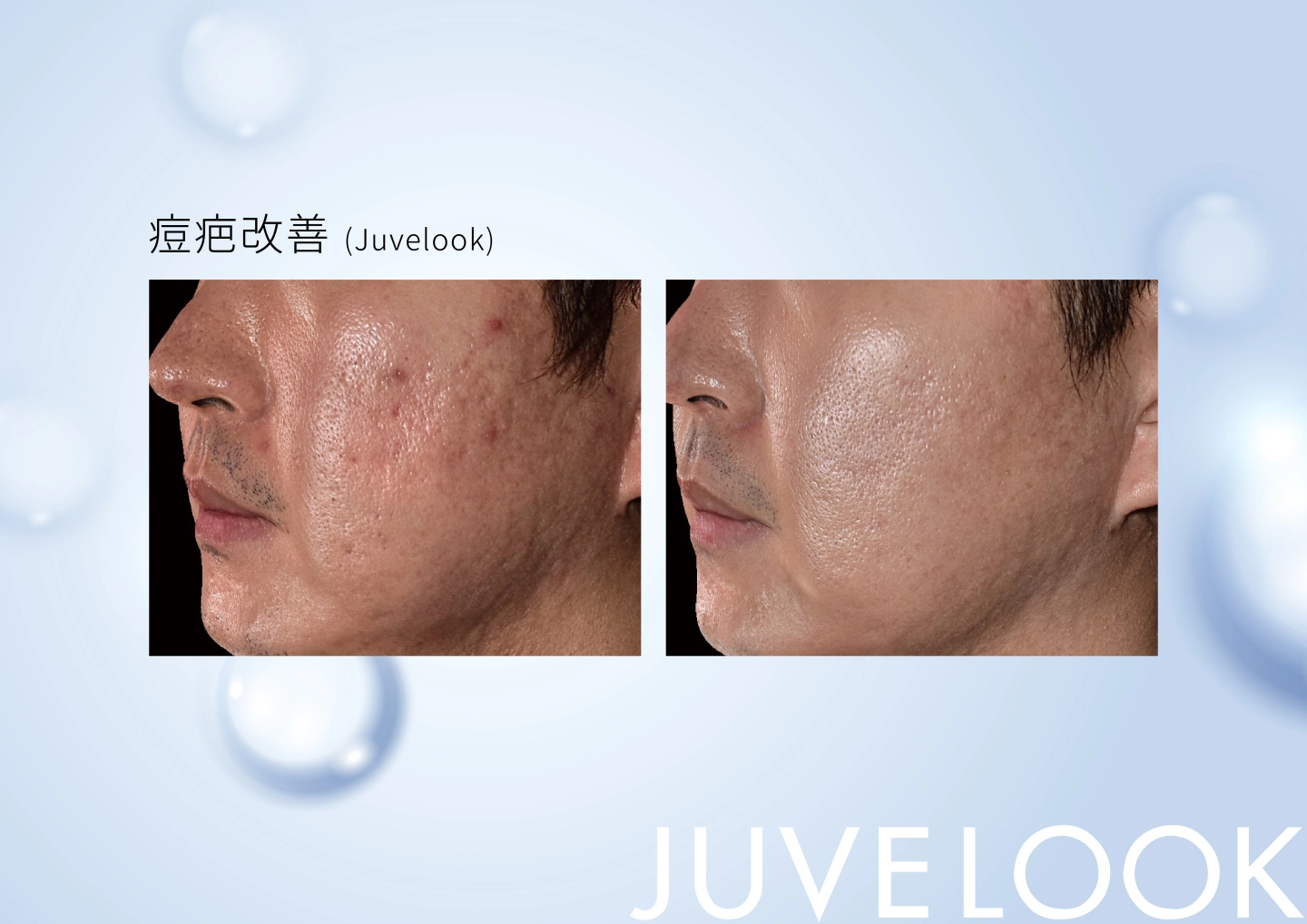誠美學診所喬雅露 / 新童妍Juvelook效果