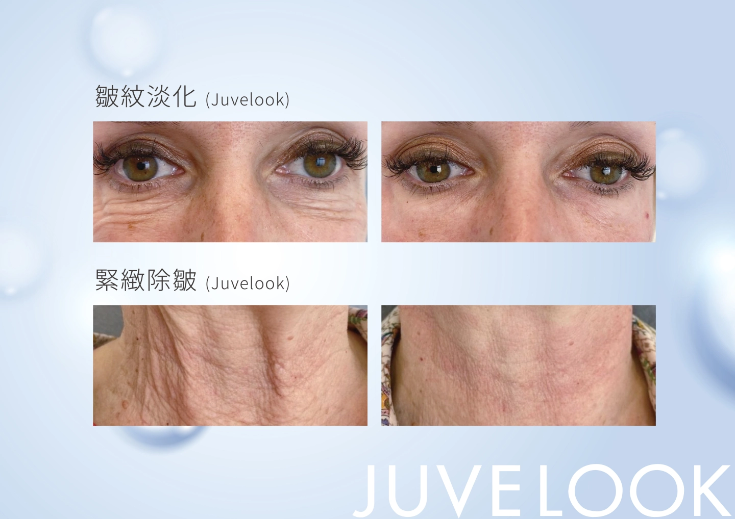 誠美學診所喬雅露 / 新童妍Juvelook除皺紋