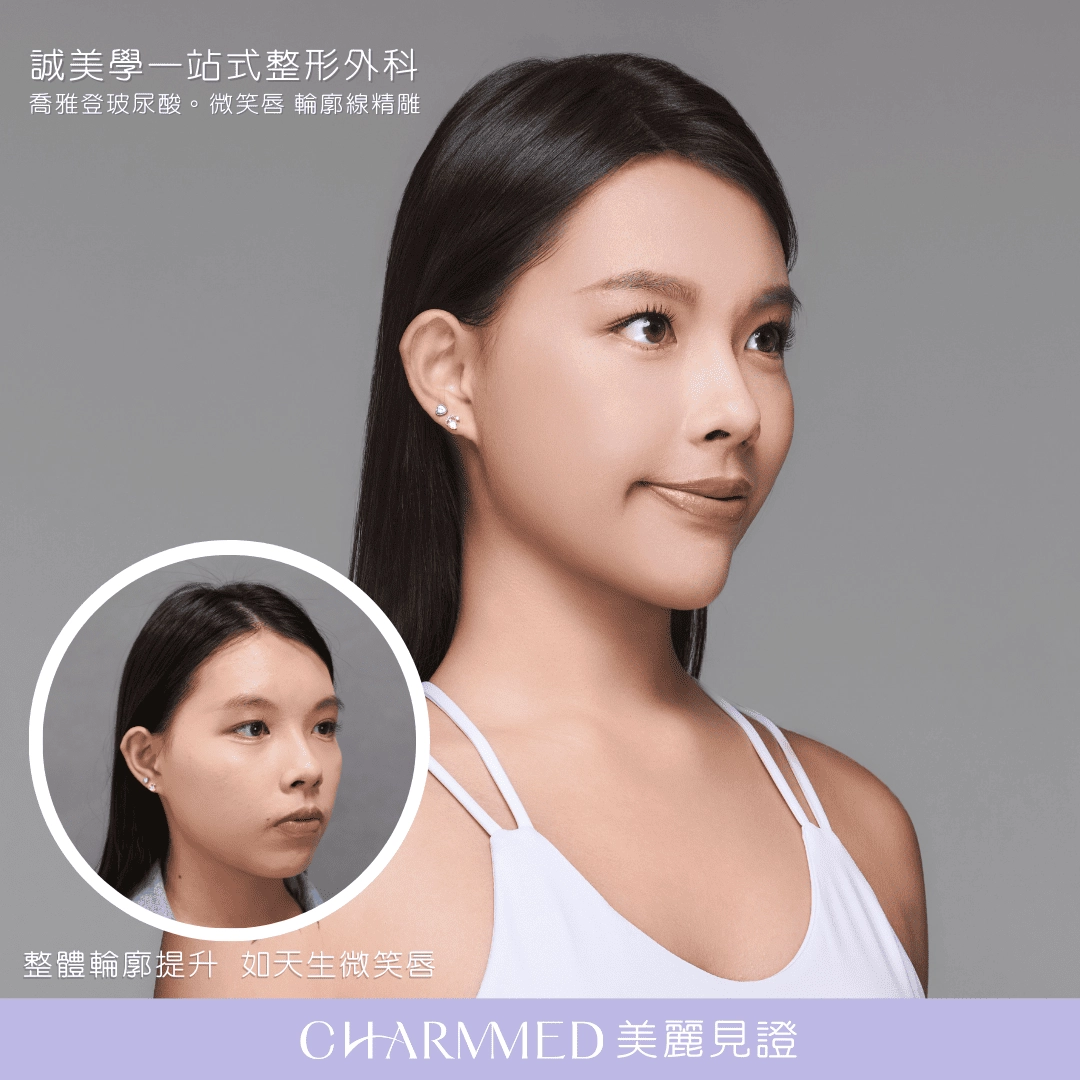 誠美學診所喬雅登玻尿酸整體輪廓提升