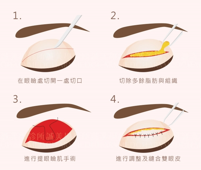 誠美學提眼瞼肌療程介紹
