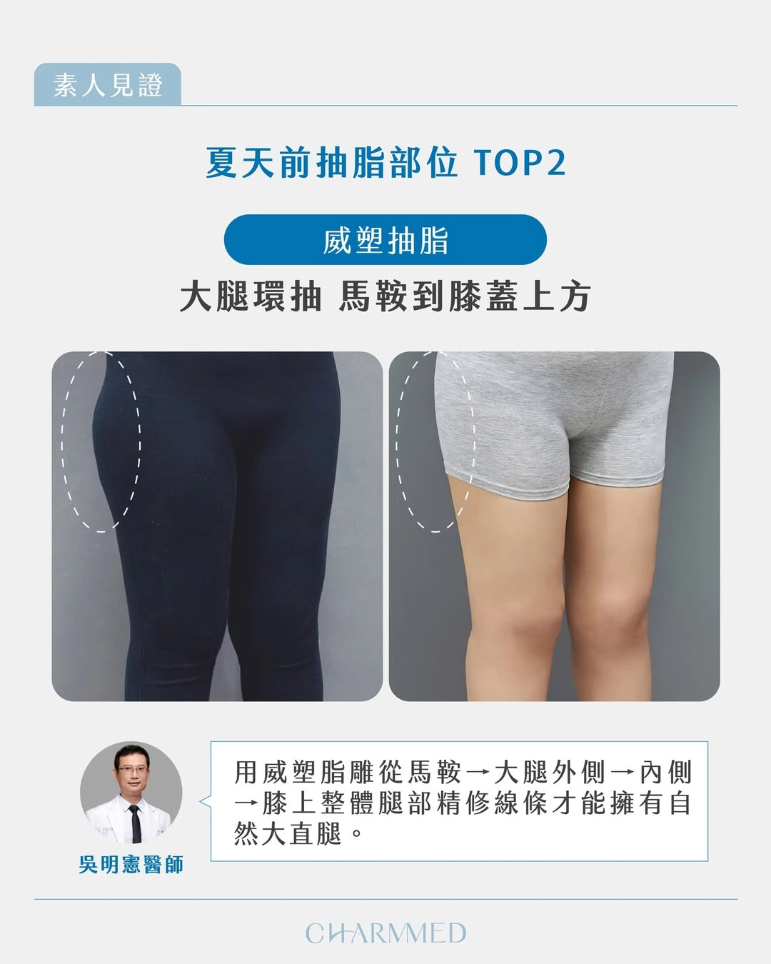夏天抽脂熱門部位TOP5|吳明憲醫師大腿環抽