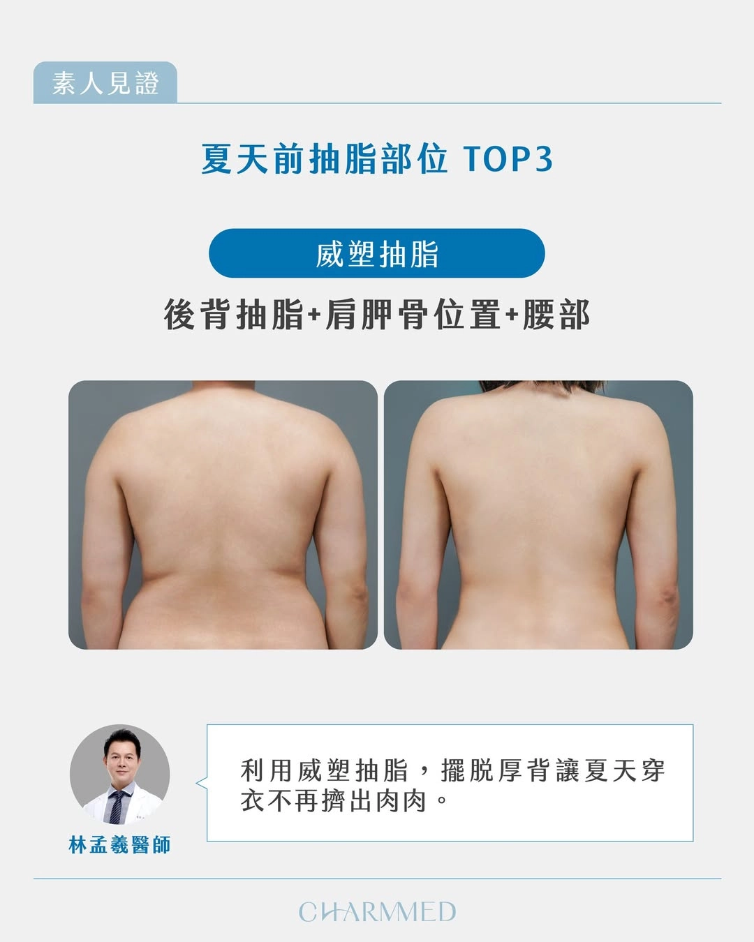 背部+後腰抽脂|林孟羲醫師|改善厚背與穿衣擠肉