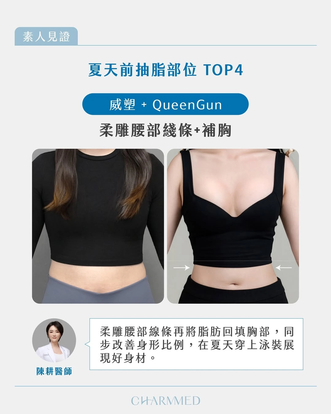 腰線雕塑+自體脂肪補胸|陳耕醫師|同時改善身形比例