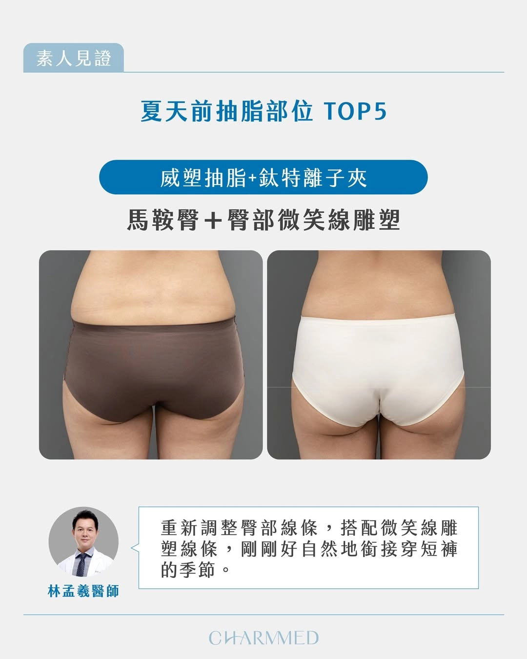 馬鞍臀+臀線雕塑|林孟羲醫師|改善臀腿比例